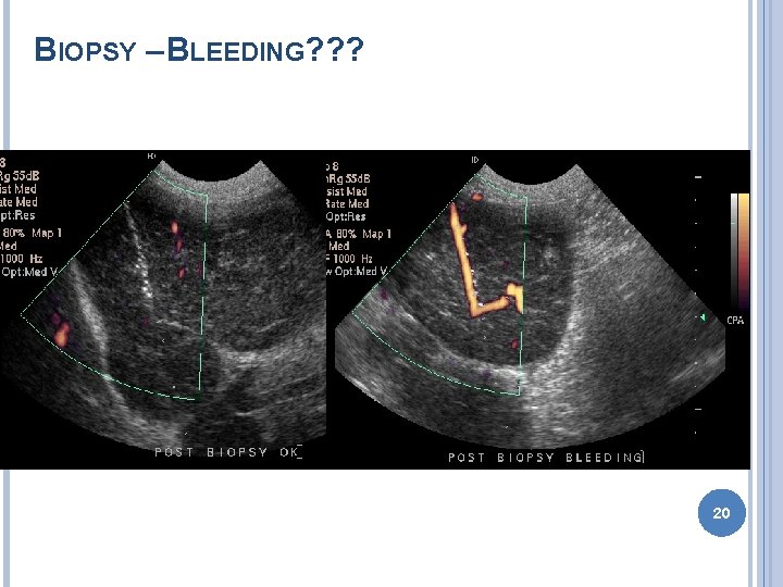 BIOPSY – BLEEDING? ? ? 20 