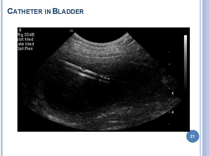 CATHETER IN BLADDER 21 