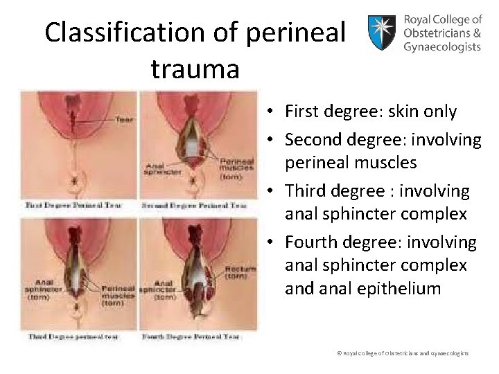 Classification of perineal trauma • First degree: skin only • Second degree: involving perineal