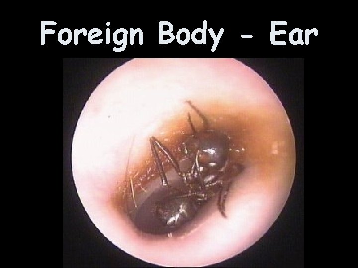 Foreign Body - Ear 
