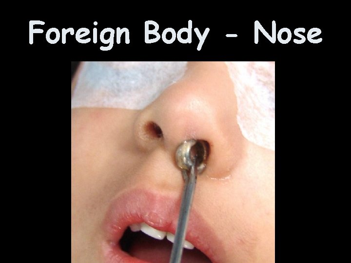 Foreign Body - Nose 