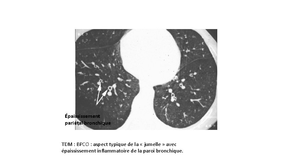 Épaississement pariétal bronchique TDM : BPCO : aspect typique de la « jumelle »