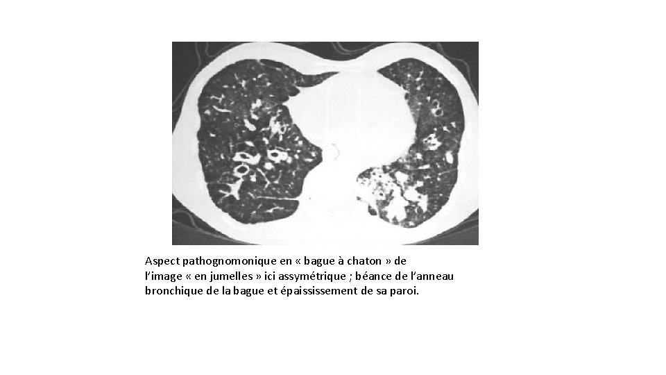 Aspect pathognomonique en « bague à chaton » de l’image « en jumelles »