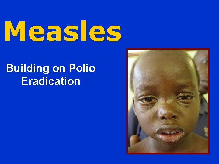 Measles Building on Polio Eradication 