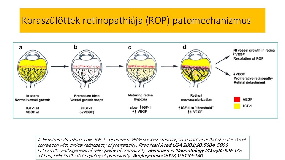 Koraszülöttek retinopathiája (ROP) patomechanizmus A Hellstrom és mtsai: Low IGF-1 suppresses VEGF-survival signaling in