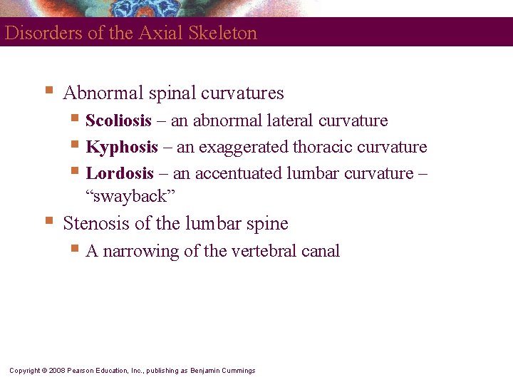 Disorders of the Axial Skeleton § Abnormal spinal curvatures § Scoliosis – an abnormal