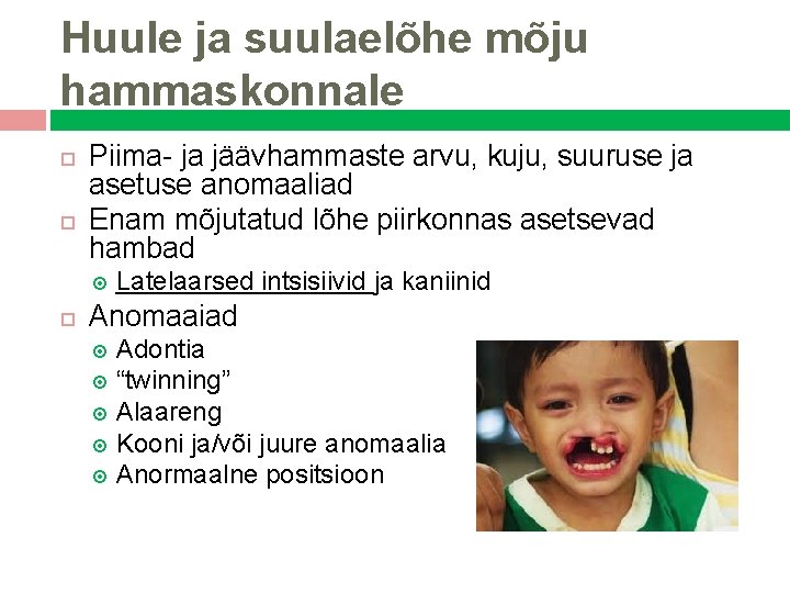 Huule ja suulaelõhe mõju hammaskonnale Piima- ja jäävhammaste arvu, kuju, suuruse ja asetuse anomaaliad