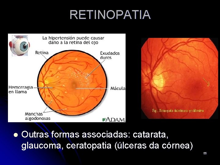 RETINOPATIA l Outras formas associadas: catarata, glaucoma, ceratopatia (úlceras da córnea) 55 