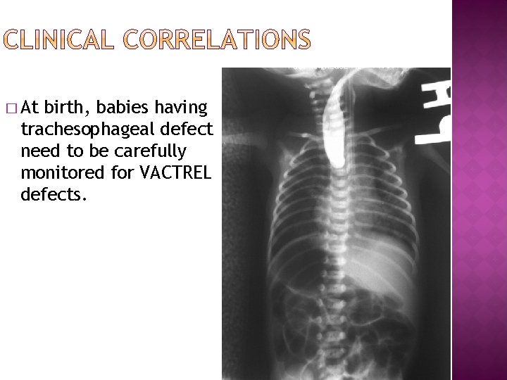 � At birth, babies having trachesophageal defect need to be carefully monitored for VACTREL