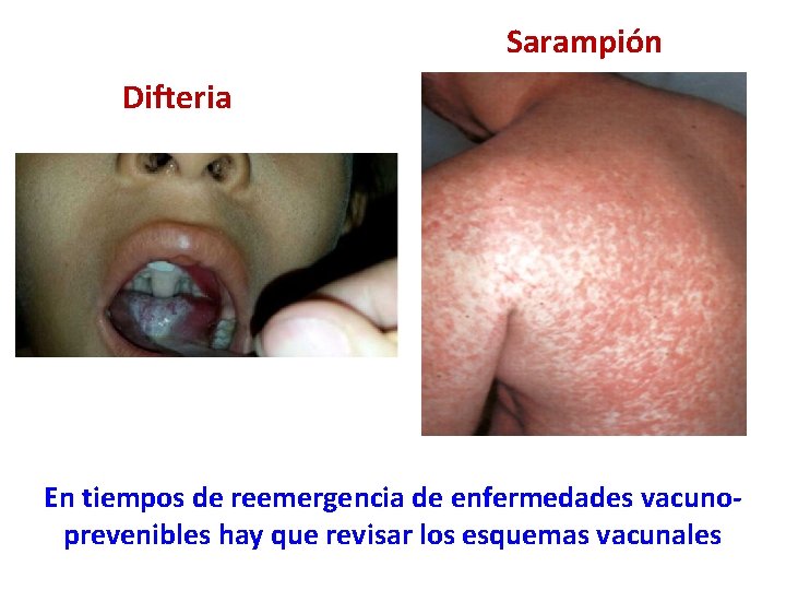 Sarampión Difteria En tiempos de reemergencia de enfermedades vacunoprevenibles hay que revisar los esquemas