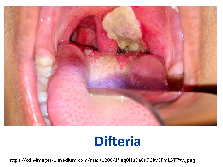 Difteria https: //cdn-images-1. medium. com/max/1200/1*aq 0 Hu 0 a 0 d 6 CKy 0
