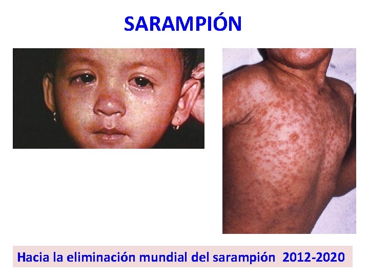 SARAMPIÓN Hacia la eliminación mundial del sarampión 2012 -2020 
