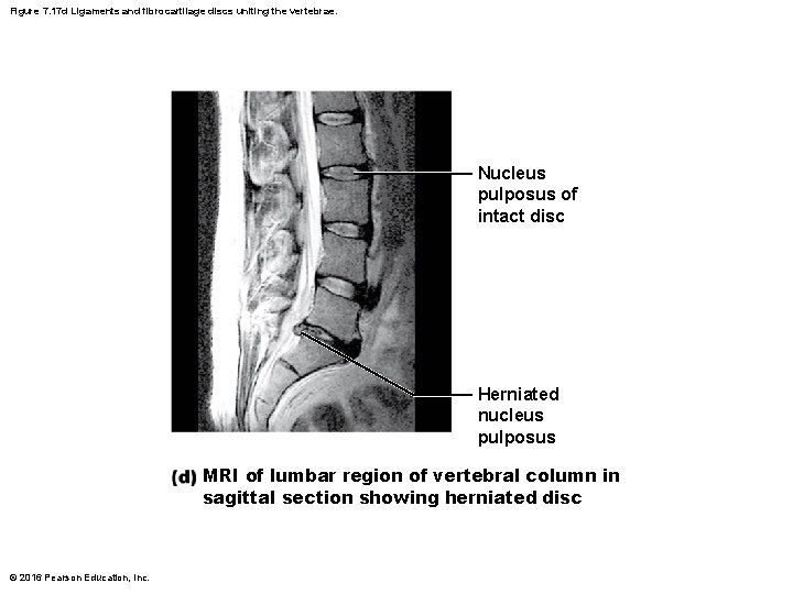 Figure 7. 17 d Ligaments and fibrocartilage discs uniting the vertebrae. Nucleus pulposus of