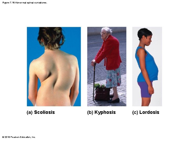 Figure 7. 18 Abnormal spinal curvatures. Scoliosis © 2016 Pearson Education, Inc. Kyphosis Lordosis