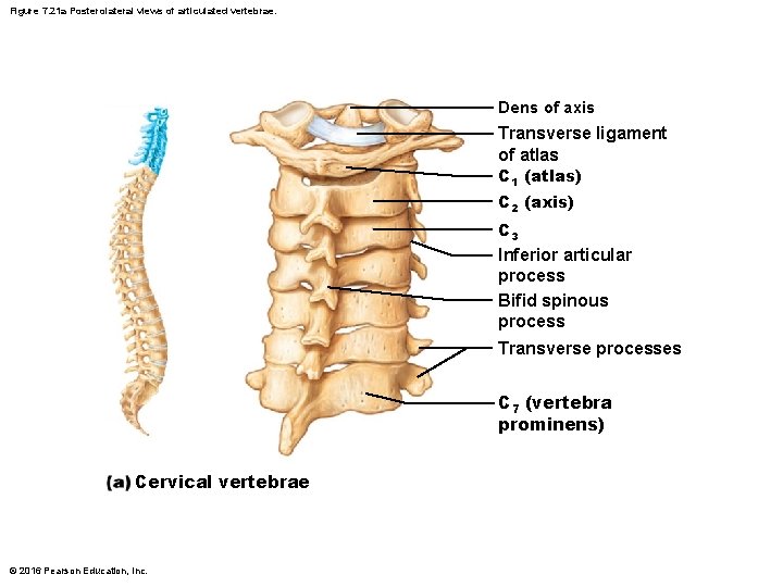 Figure 7. 21 a Posterolateral views of articulated vertebrae. Dens of axis Transverse ligament