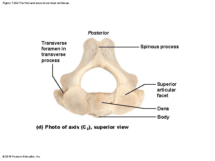 Figure 7. 20 d The first and second cervical vertebrae. Posterior Transverse foramen in