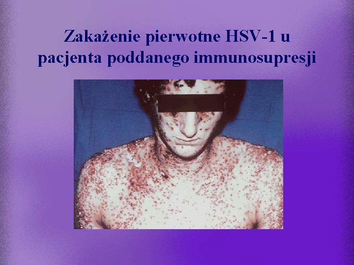 Zakażenie pierwotne HSV-1 u pacjenta poddanego immunosupresji 