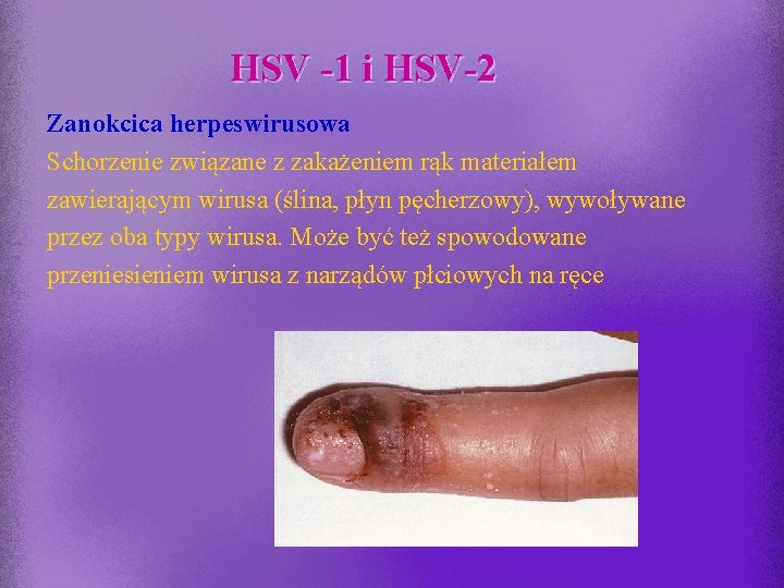 HSV -1 i HSV-2 Zanokcica herpeswirusowa Schorzenie związane z zakażeniem rąk materiałem zawierającym wirusa