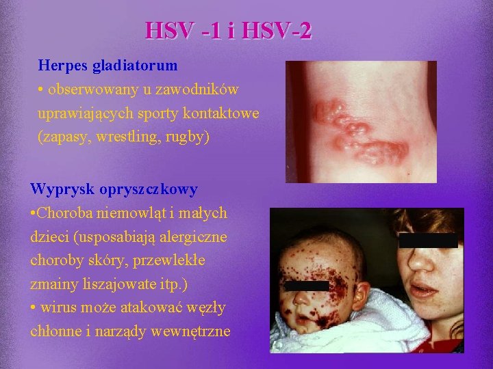 HSV -1 i HSV-2 Herpes gladiatorum • obserwowany u zawodników uprawiających sporty kontaktowe (zapasy,