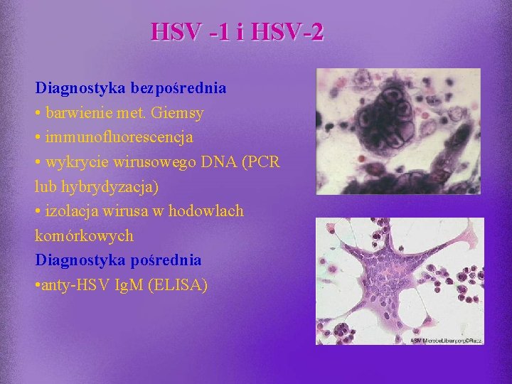 HSV -1 i HSV-2 Diagnostyka bezpośrednia • barwienie met. Giemsy • immunofluorescencja • wykrycie