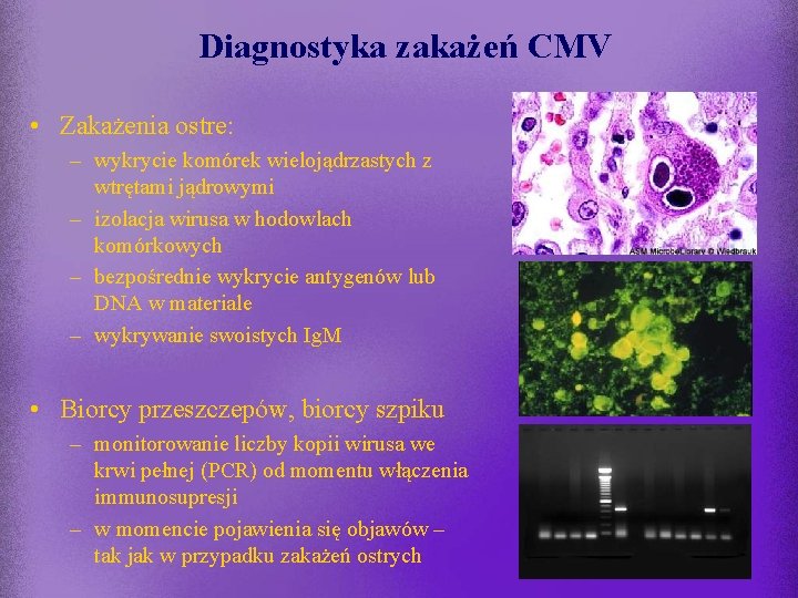 Diagnostyka zakażeń CMV • Zakażenia ostre: – wykrycie komórek wielojądrzastych z wtrętami jądrowymi –