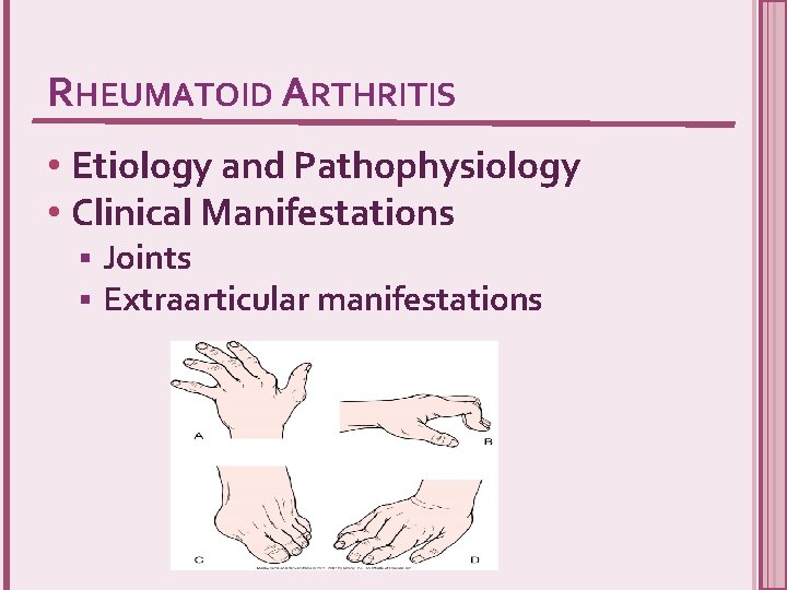 RHEUMATOID ARTHRITIS • Etiology and Pathophysiology • Clinical Manifestations § § Joints Extraarticular manifestations