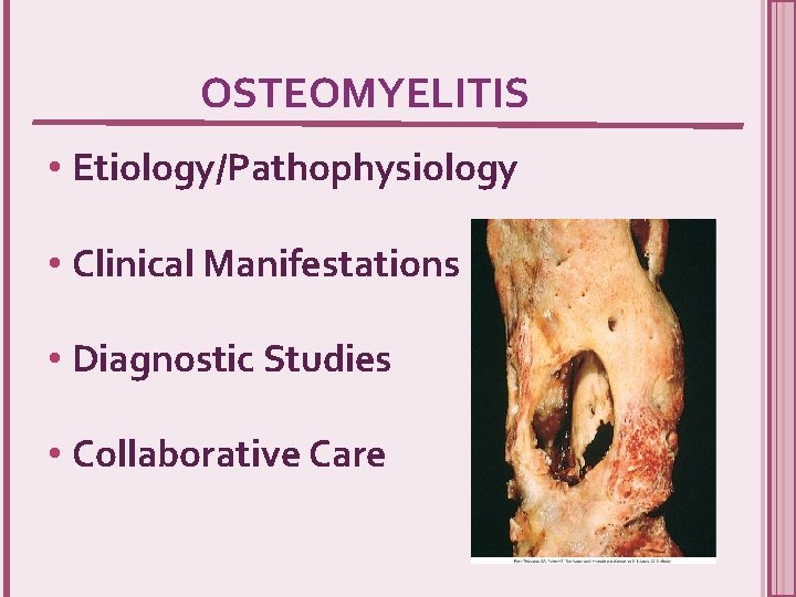 OSTEOMYELITIS • Etiology/Pathophysiology • Clinical Manifestations • Diagnostic Studies • Collaborative Care 