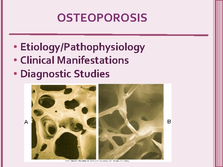 OSTEOPOROSIS • Etiology/Pathophysiology • Clinical Manifestations • Diagnostic Studies 