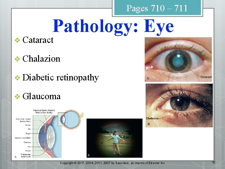 Pages 710 – 711 Pathology: Eye v Cataract v Chalazion v Diabetic retinopathy v
