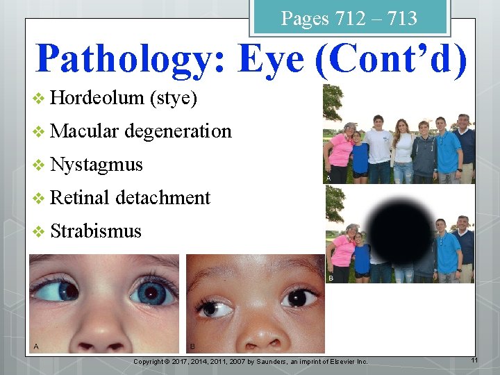 Pages 712 – 713 Pathology: Eye (Cont’d) v Hordeolum v Macular (stye) degeneration v