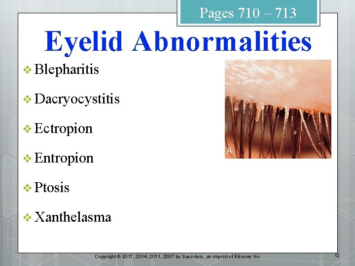 Pages 710 – 713 Eyelid Abnormalities v Blepharitis v Dacryocystitis v Ectropion v Entropion