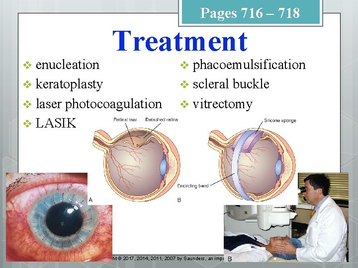 Pages 716 – 718 Treatment enucleation v keratoplasty v laser photocoagulation v LASIK v