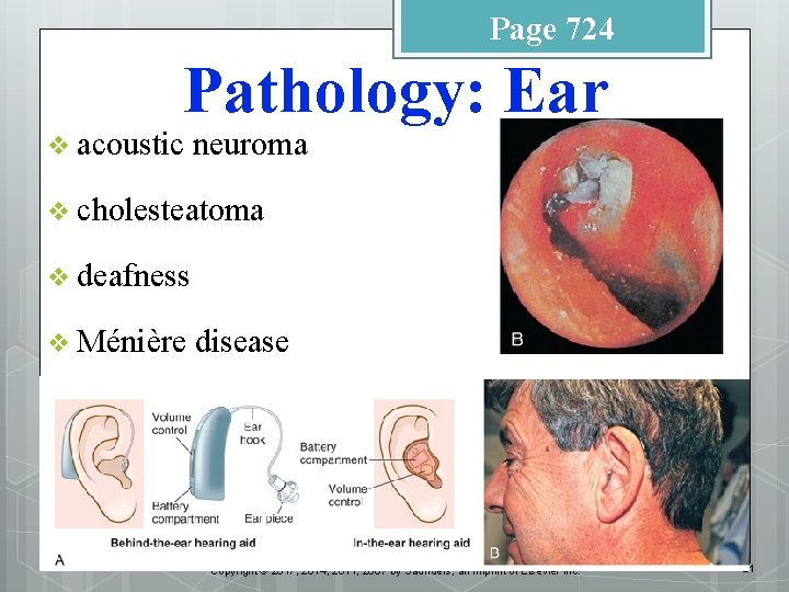 Page 724 Pathology: Ear v acoustic neuroma v cholesteatoma v deafness v Ménière disease