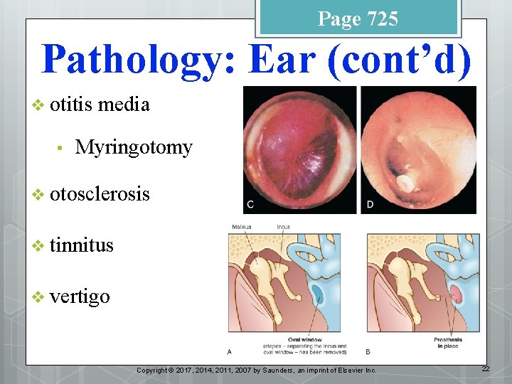 Page 725 Pathology: Ear (cont’d) v otitis • media Myringotomy v otosclerosis v tinnitus