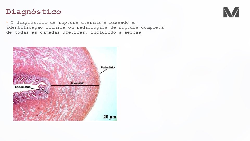 Diagnóstico • O diagnóstico de ruptura uterina é baseado em identificação clínica ou radiológica