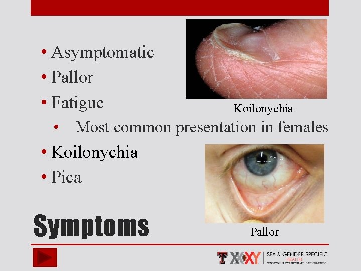  • Asymptomatic • Pallor • Fatigue Koilonychia • Most common presentation in females