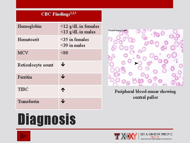 CBC Findings 1, 2, 3 Hemoglobin <12 g/d. L in females <13 g/d. L