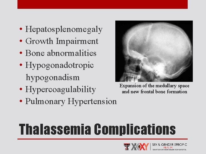  • • Hepatosplenomegaly Growth Impairment Bone abnormalities Hypogonadotropic hypogonadism Expansion of the medullary