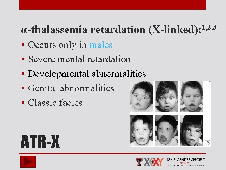 α-thalassemia retardation (X-linked): 1, 2, 3 • • • Occurs only in males Severe