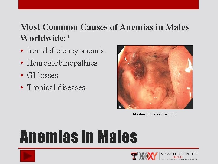 Most Common Causes of Anemias in Males Worldwide: 1 • • Iron deficiency anemia