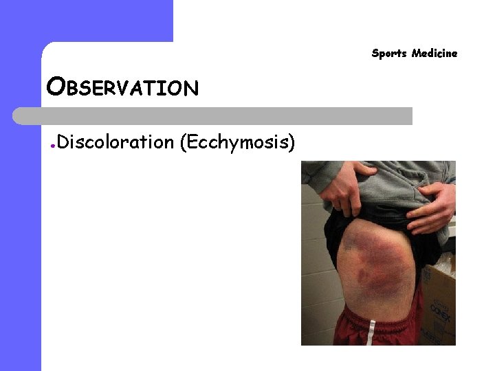 Sports Medicine OBSERVATION ● Discoloration (Ecchymosis) 