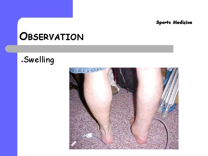 Sports Medicine OBSERVATION ● Swelling Sports Medicine OBSERVATION ● Swelling
