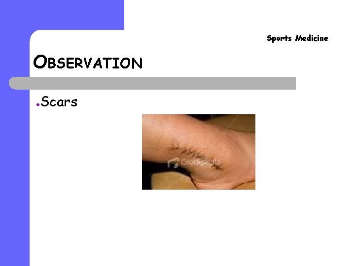 Sports Medicine OBSERVATION ● Scars Sports Medicine OBSERVATION ● Scars