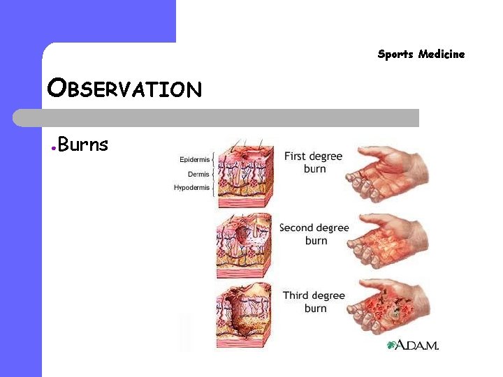 Sports Medicine OBSERVATION ● Burns 