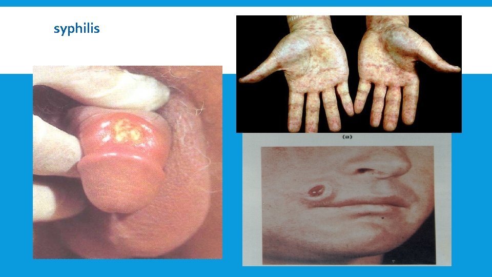 syphilis: 2 -10 weeks, local, (hard chancre) 