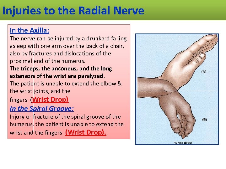 Injuries to the Radial Nerve In the Axilla: The nerve can be injured by