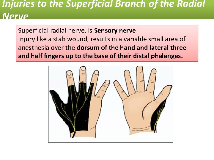 Injuries to the Superficial Branch of the Radial Nerve Superficial radial nerve, is Sensory
