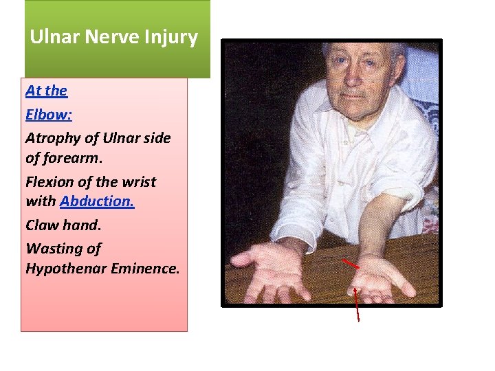 Ulnar Nerve Injury At the Elbow: Atrophy of Ulnar side of forearm. Flexion of