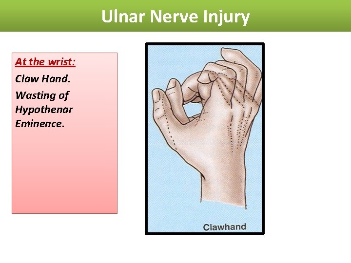 Ulnar Nerve Injury At the wrist: Claw Hand. Wasting of Hypothenar Eminence. 