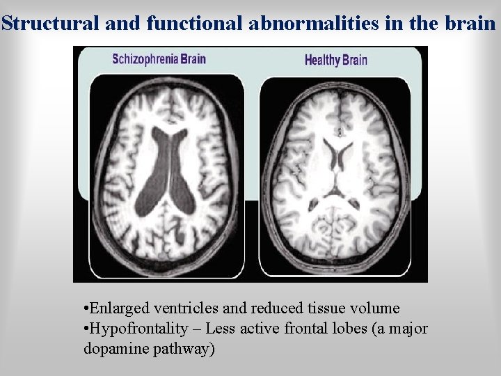 Structural and functional abnormalities in the brain • Enlarged ventricles and reduced tissue volume